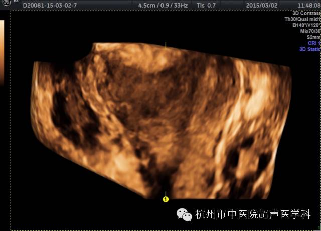 子宫畸形的超声诊断