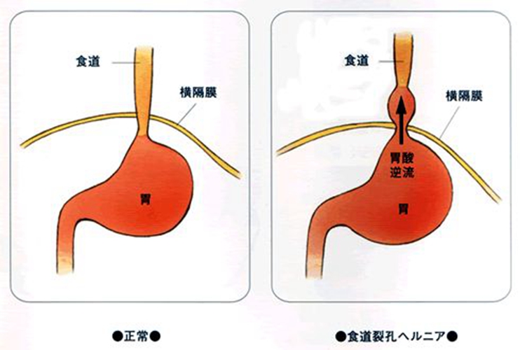 反流性食道炎癥狀