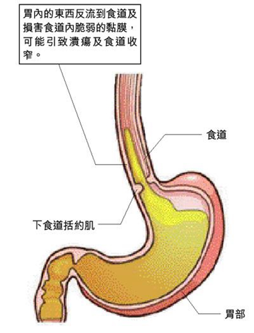 反流式食道炎