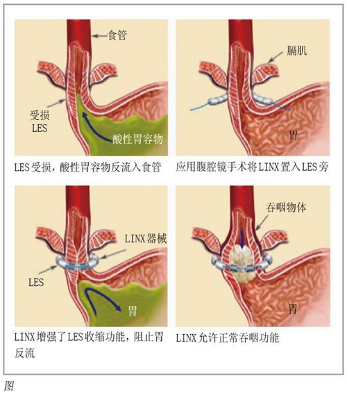 反流性食道炎 根治