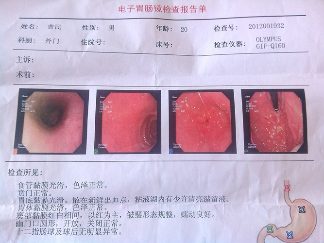 糜爛性食道炎癥狀