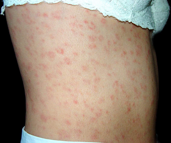早期梅毒感染症状图图片