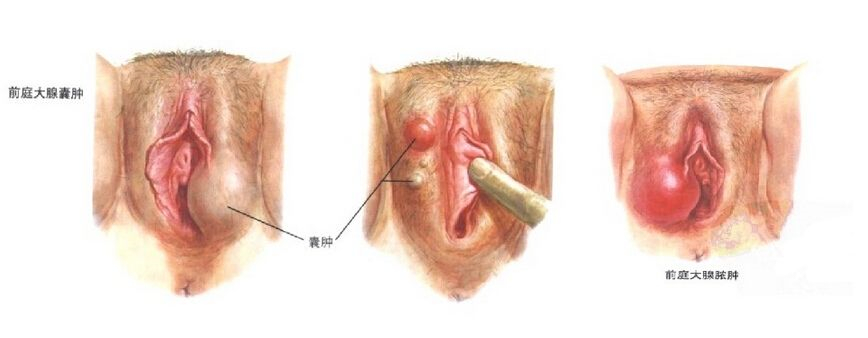 陰道口處的囊腫圖片