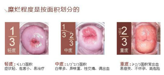 子宮糜爛3度癥狀圖片