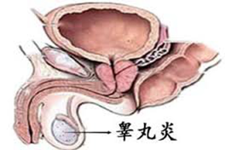 睾丸炎图片