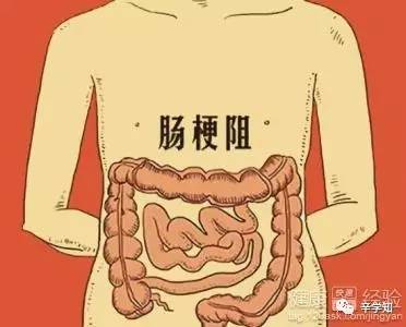 小科普:结肠梗阻