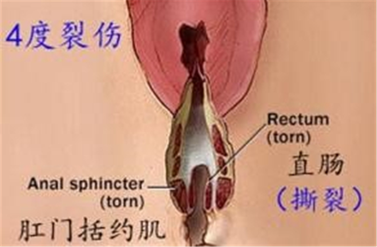 陰道口四度撕裂圖片