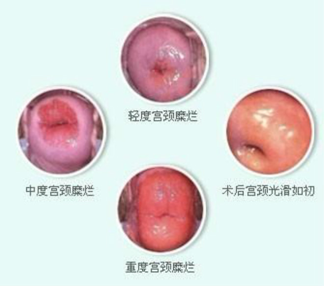 子宮糜爛微創(chuàng)手圖