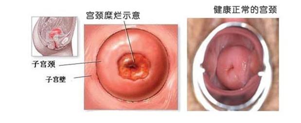 輕度子宮糜爛的癥狀圖
