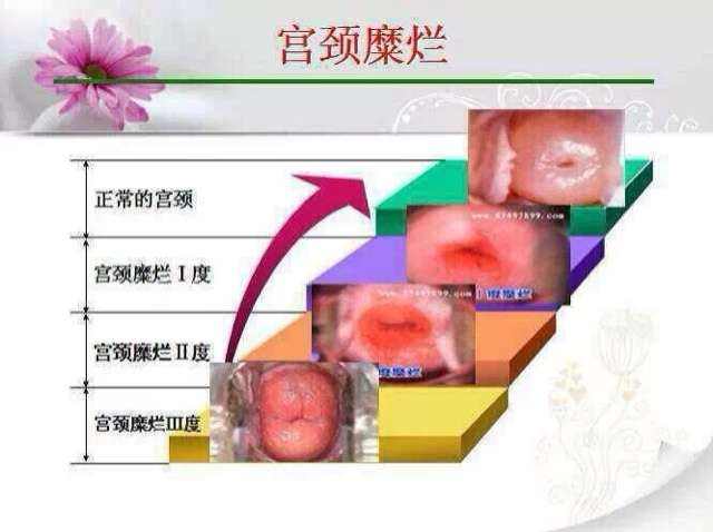 子宮糜爛4度的癥狀圖片