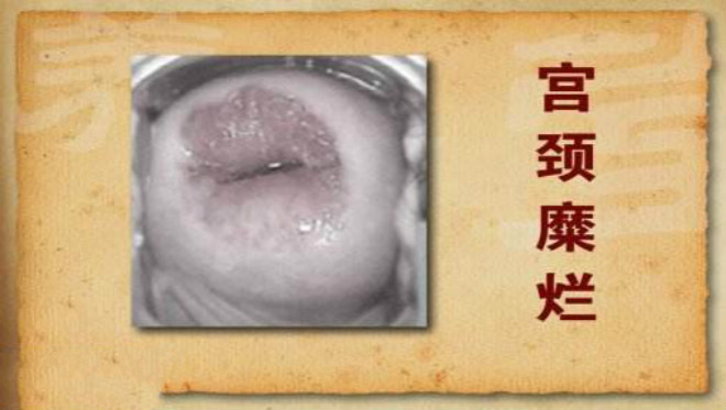 子宮糜爛1度圖片