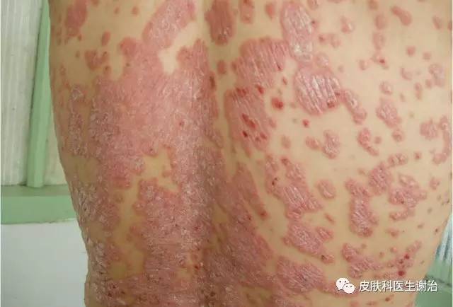 银屑病,俗称牛皮癣,是一种常见的慢性,炎症性,易复发皮肤顽疾,其特征