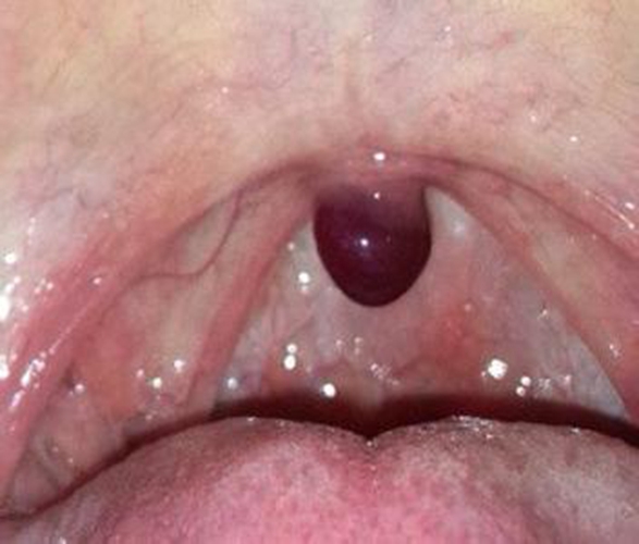 咽炎和咽喉癌的区别图片
