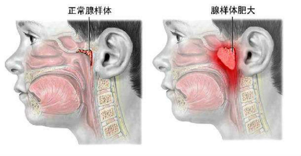 咽扁桃体癌