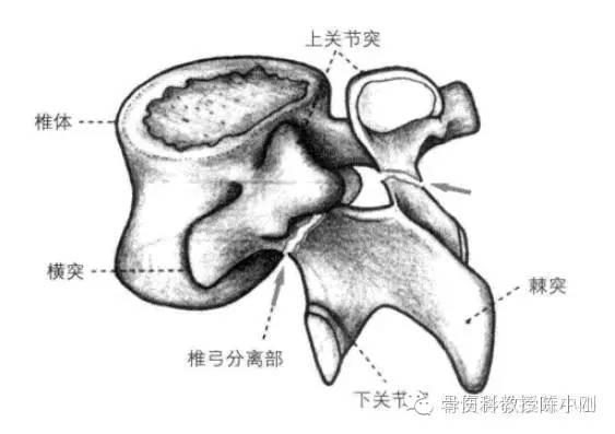 好发于第4,第5腰椎水平,原因是椎弓峡部断裂所引起的椎体移位,患者