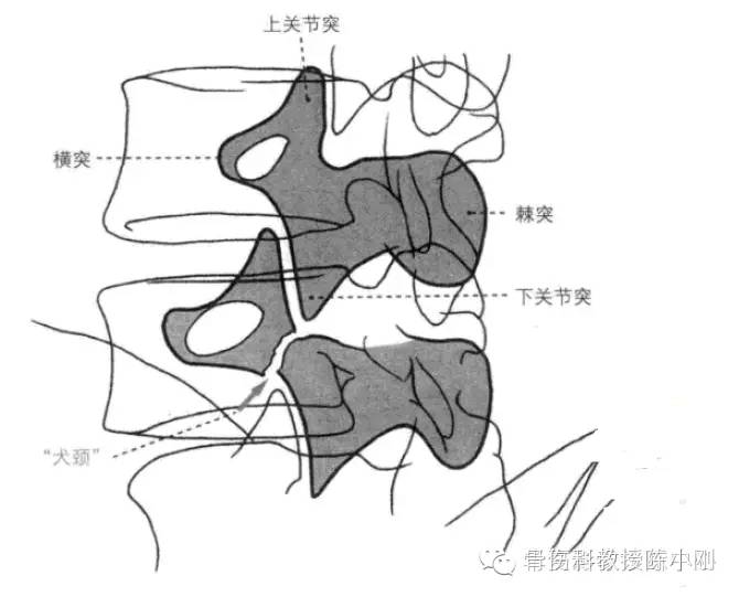 如图3   腰椎斜位(45度)拍片,腰椎峡部裂尤如"狗戴项链".