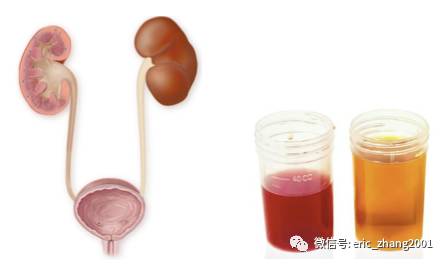 尿血问题真不少:镜下血尿和尿潜血_张弋_中华康网