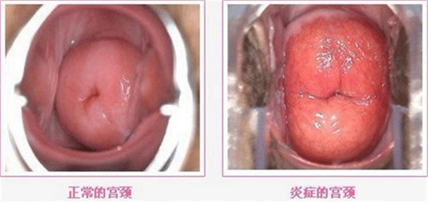 重度宮頸糜爛圖 (11)