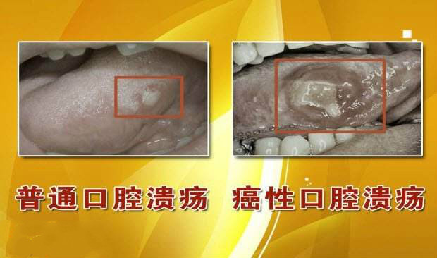 口腔癌的早期癥狀圖（52）