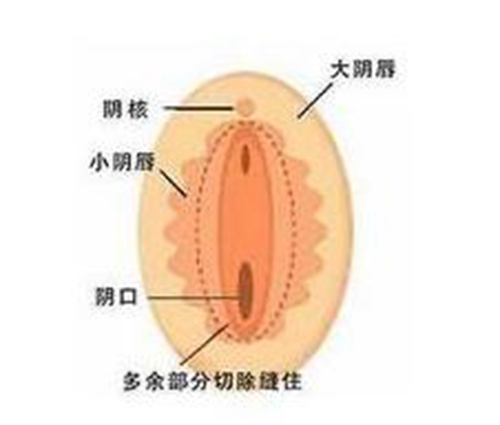 陰唇肥大和正常圖