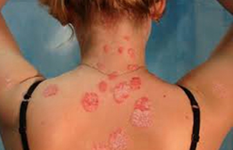 艾滋病初期背部红斑点症状图片