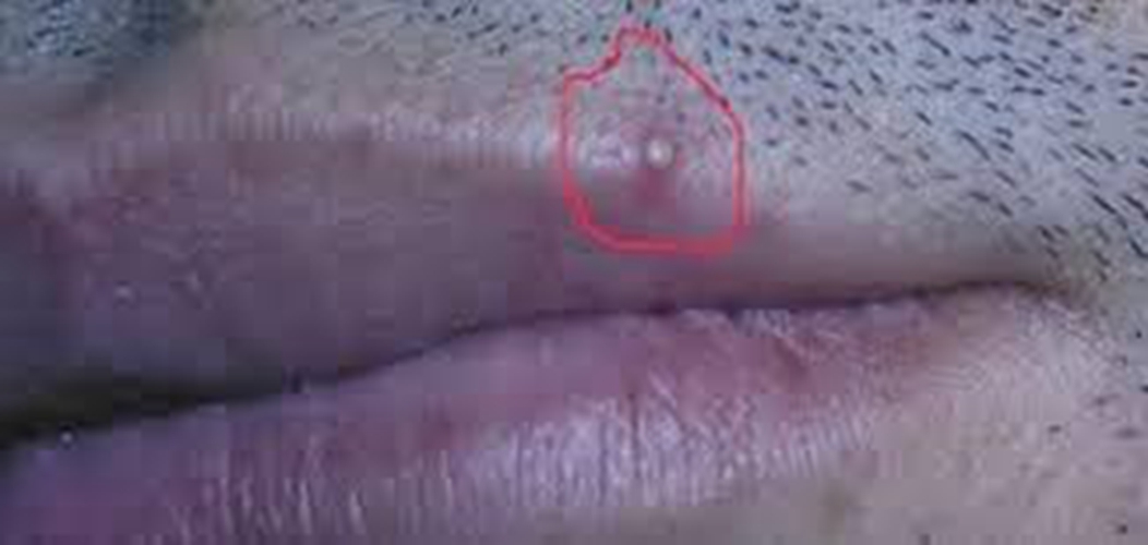 艾滋病初期嘴唇上部症状图片