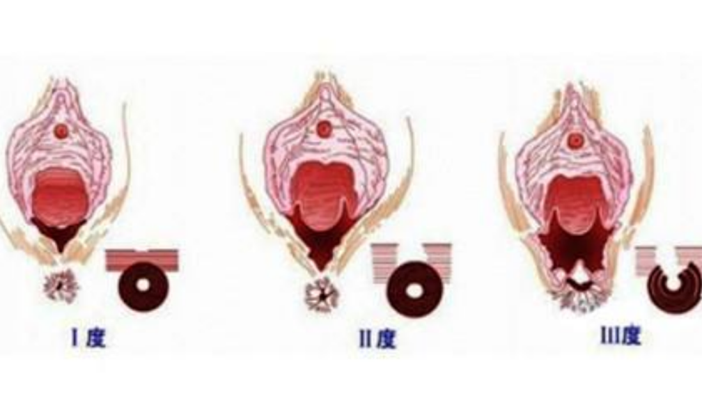 会阴撕裂如何分度图片_有来医生
