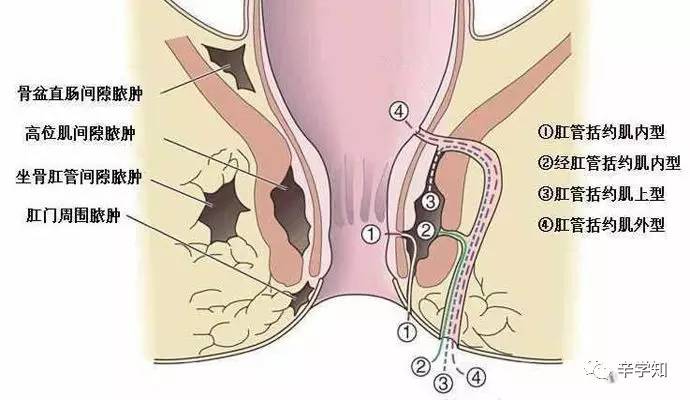 首先肛瘘感染发炎后,肛门疼痛剧烈,溃破后脓水污染内裤,脓汁刺激局部
