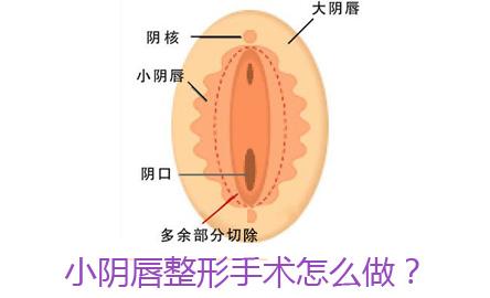 小陰唇肥大縮小術(shù)圖片