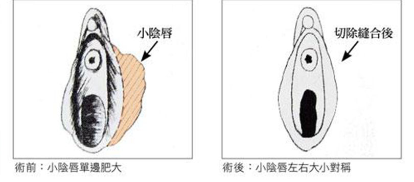 小陰唇肥大外翻的圖片