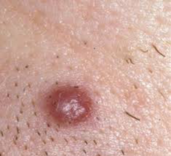艾滋病初期指甲盖症状图片