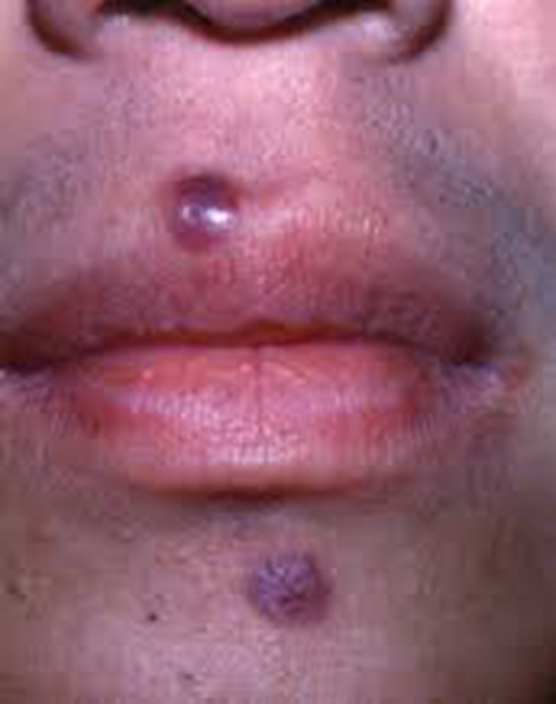 艾滋病初期嘴唇上下症状图片