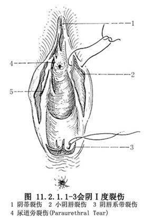会阴撕裂如何分度图片_有来医生