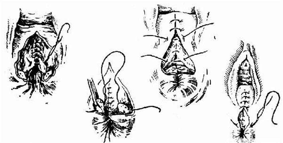 三度会阴撕裂手术的图片