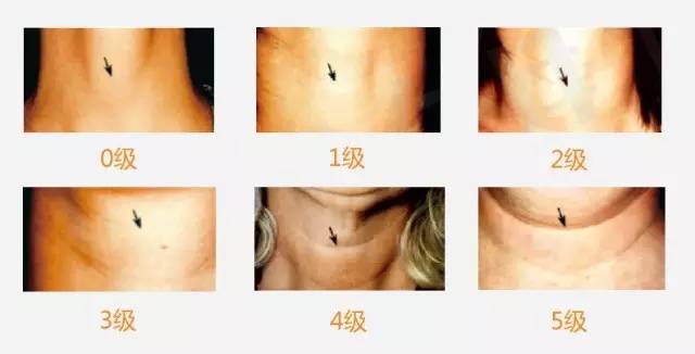 Hearty嗨体--真皮细胞赋活法轻松去颈纹!