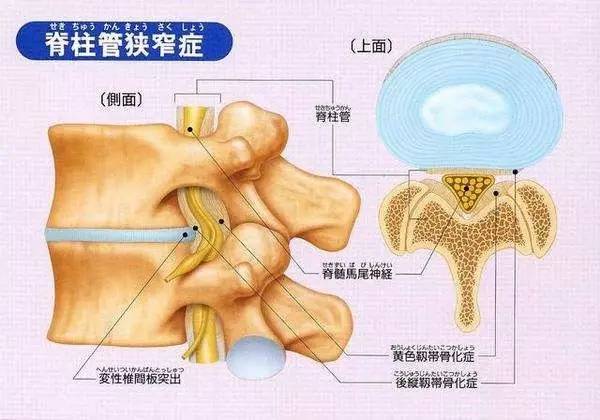 腰椎管狭窄症的康复训练