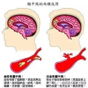 脑梗塞和脑出血的区别