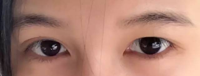 通过双眼皮手术,可使睫毛向上翘着生长.
