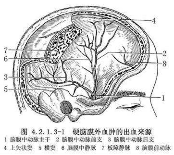 硬脑膜下血肿