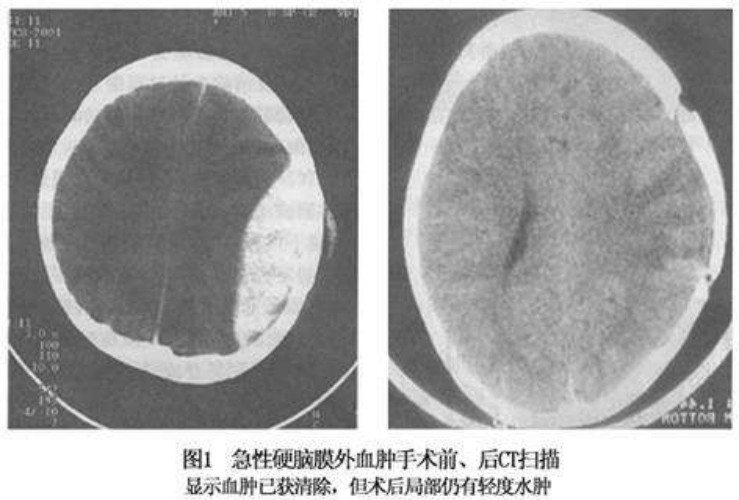 硬脑膜下血肿