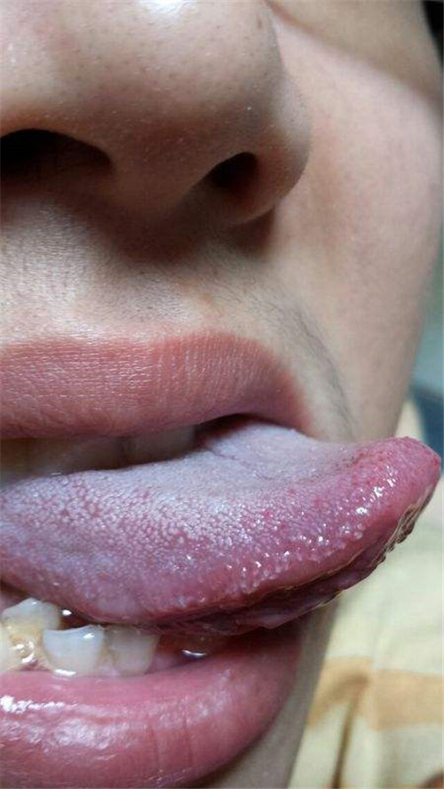 嘴唇白色念珠菌感染