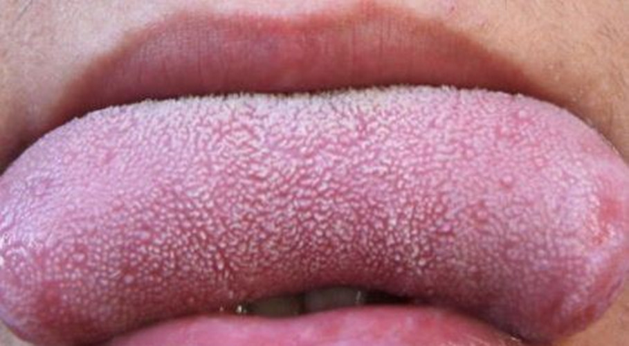 舌头白色念珠菌感染