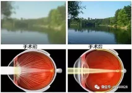 白内障致盲率高?存在诸多误区!