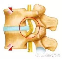 椎间盘退变与生物力学