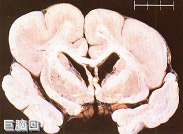 了解无脑回巨脑回半侧巨脑畸形