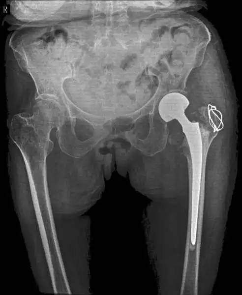 骨水泥型加长柄髋关节置换治疗高龄股骨粗隆间