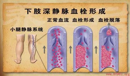 下肢静脉曲张可以做手术,不是很复杂的,严重的手术效果最好,现在有