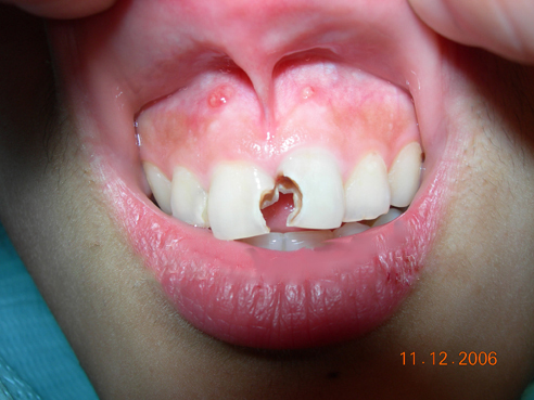 牙龈瘘管 (7)