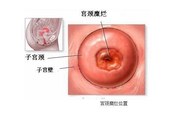 子宮糜爛的癥狀圖 (12)