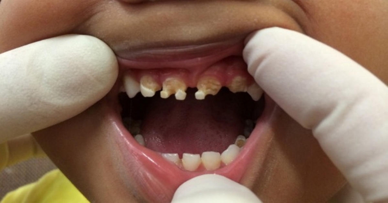 儿童牙齿发黑龋齿图片 (5)